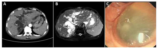  Imaging of IPNM-B: (A) Typical CT manifestations showed obvious cystic dilatation of the intrahepatic bile duct, a small spot-shaped high-density lesion in the bile duct of the right hepatic lobe. (B) T2 magnetic resonance imaging showed a clear soft vine-like expansion of the intrahepatic bile duct, and a small nodular T2 signal foci in the bile duct. (C) The duodenoscopy showed a common bile duct duodenal fistula by below the duodenum above the duodenal papilla, about 1.0 cm in diameter, full filled with full of jelly-like Slime.