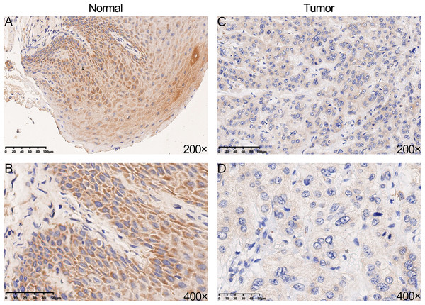 The protein expression of YTHDC2 in head and neck squamous cell carcinoma (HNSCC) and normal oral tissues.