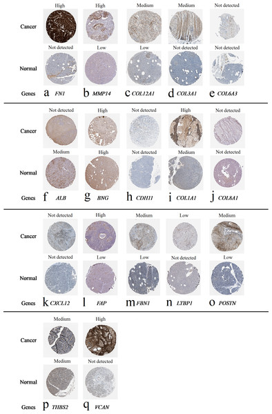 Expression of 20 candidate DEGs in human pancreatic cancer specimens.