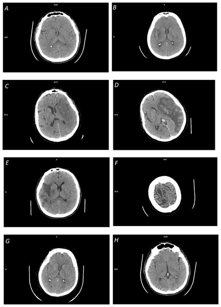 Illustration of space-dependent ischemic stroke changes on NCCT scans: