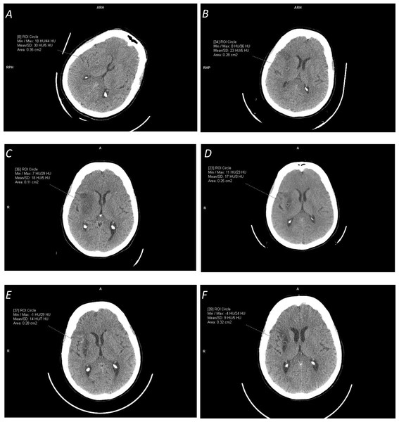 Illustration of time-dependent ischemic stroke changes in terms of appearance and Hounsfield Unit (HU) density characteristics (measured in the marked circular regions) for the same patient for the stroke onset after: