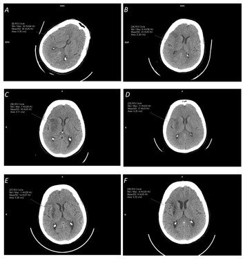 Ischemic infarct detection, localization, and segmentation in ...