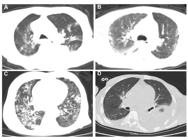 Chest CT imaging of four hemodialysis patients.