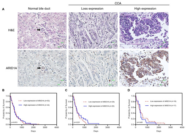 Representative images showing immunohistochemical staining for ARID1A in CCA.