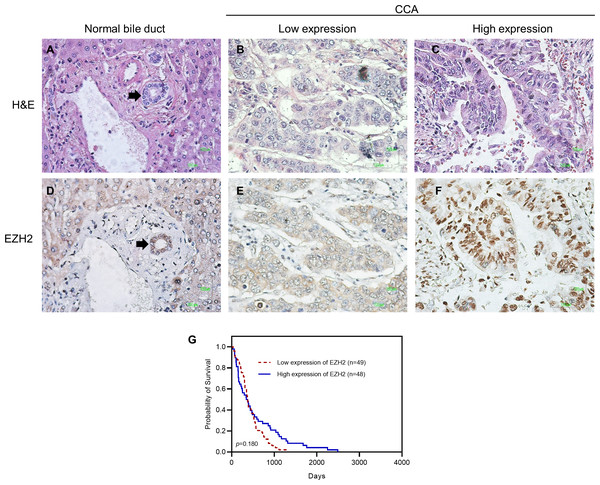 Representative images showing immunohistochemical staining for EZH2 in CCA.