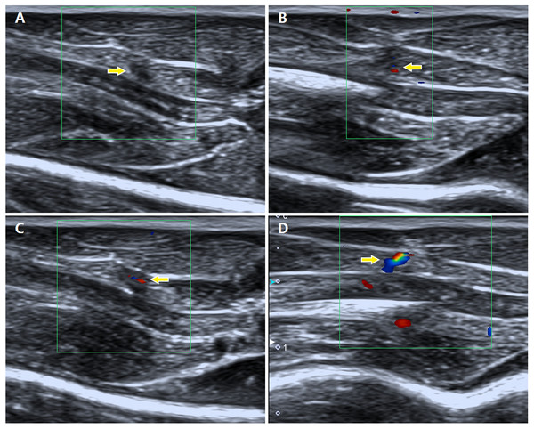 Description of different grades of blood flow signals in the MTrPs observed using colour Doppler flow imaging.