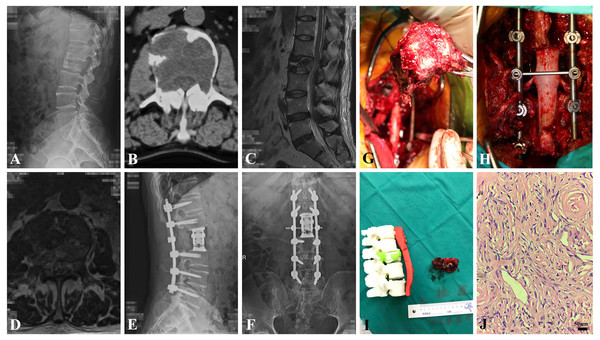 The clinical data of a 61-year-old male patient (adult fibrosarcoma).