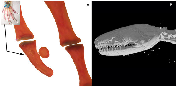 Accessory structure lateral to the terminal and subterminal phalanx of hands in Ambystoma mexicanum (FMNH22888) (A); and surrounding the skull of Ichthyophis bannanicus (MVZ236728) image credit: Digimorph.org (B).