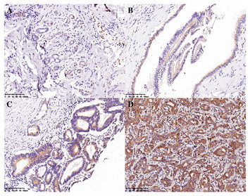 The diagnostic and prognostic value of UBE2T in intrahepatic ...