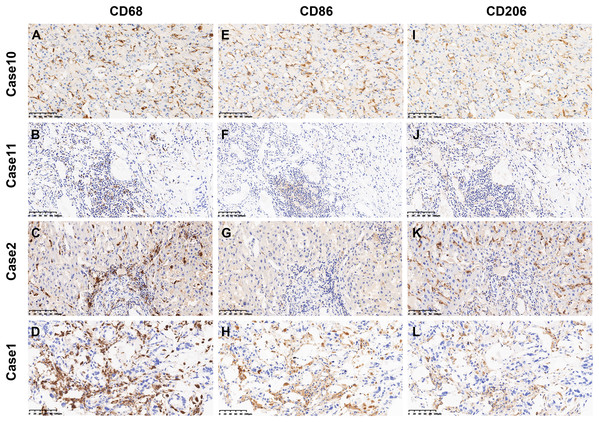 Representative images of CD68+, CD86+ and CD206+ immunostaining in ICC.