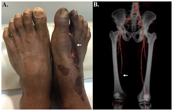 Clinical features of vascular pythiosis.