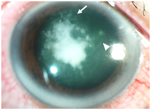 Clinical features of ocular pythiosis.