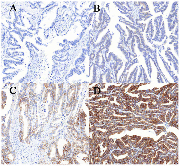 Immunohistochemical staining for human epidermal growth factor receptor 2 (HER2) in colorectal cancer.