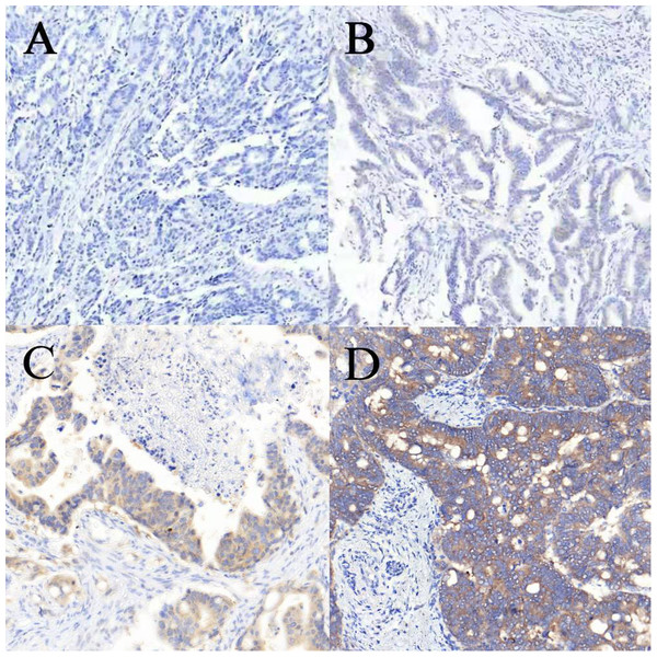 Immunohistochemical staining for BRAF V600E in colorectal cancer.