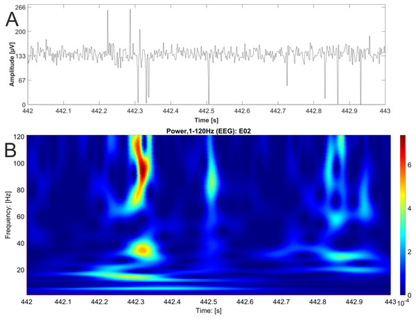 EEG raw data trace with nested activity of multiple bands.