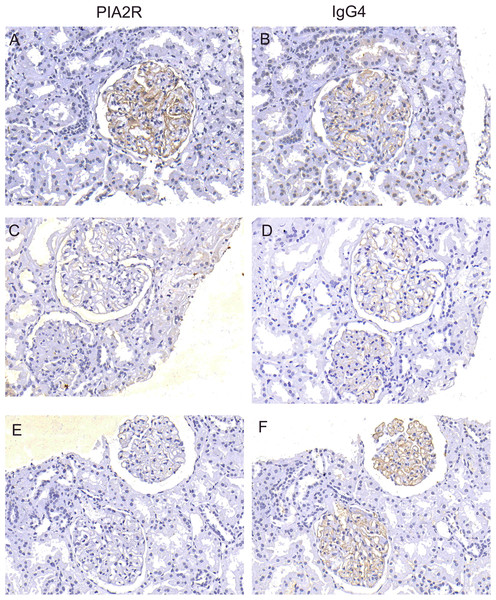 Detection of PLA2R antigen and IgG4 in renal tissue.