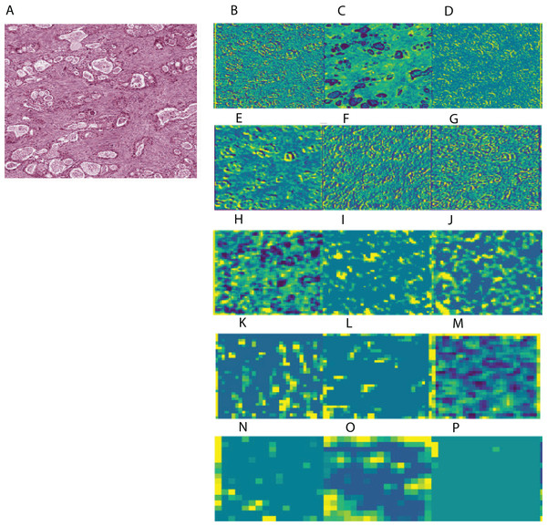 Example of feature mapping visualization in VGG 16 model in one cancer sample.