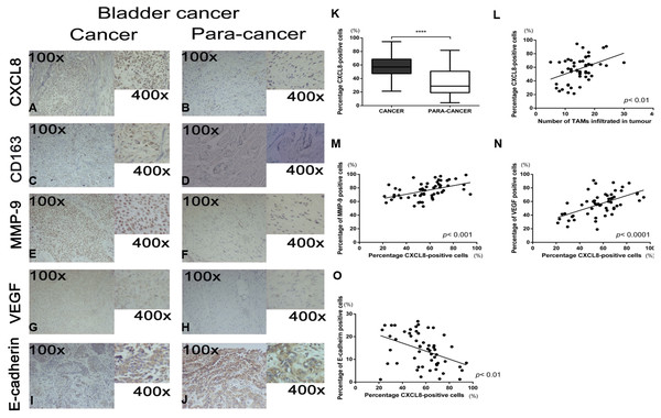 Recruitment of tumor-associatedmacrophages and CXCL8 expression in human bladder cancer, and the correlation between the expression of CXCL8 and the expression of MMP-9, VEGF, and E-cadherin.