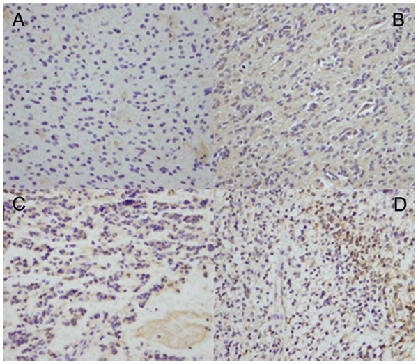NKCC1 expression was associated with the histopathological grade in human glioma tissues.