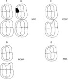 Impact of proximal cavities and primary molar absence on space in the ...