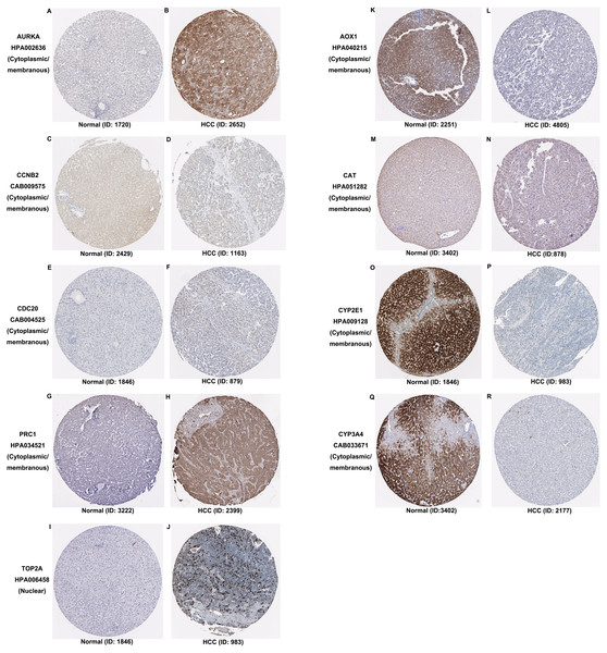 Expression and protein distribution of key genes in normal and HCC tissue measured by immunohistochemistry in the HPA database.