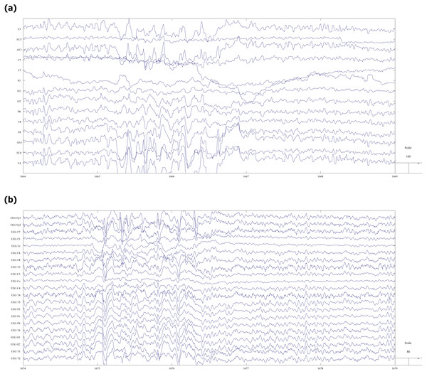 Fragment of EEG record with spike-slow wave abnormalities.
