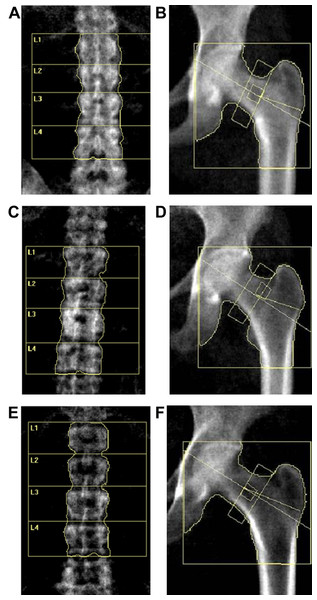 DXA scan image of the lumbar spine (L1–4) and hip for BMD measurement.