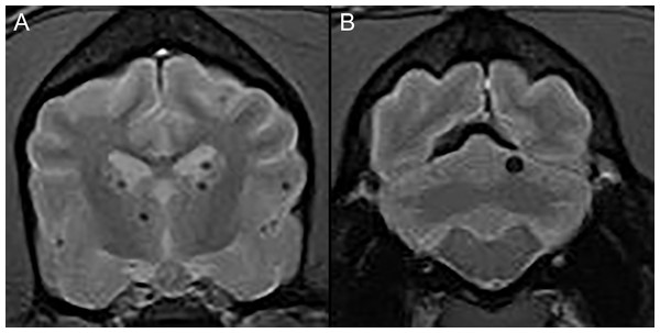 Typical examples of microhemorrhages on T2* weighted images.