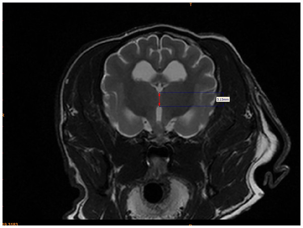 Method for measuring interthalamic adhesion height from a transverse T2 weighted image.