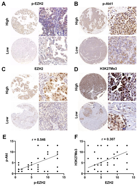 General expression of EZH2/H3K27Me3 and pAkt1/pEZH2 in ovarian cancer.