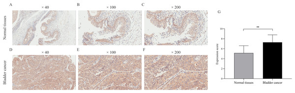 Immunohistochemical detection of CDCA8 expression in normal bladder tissue and bladder cancer.