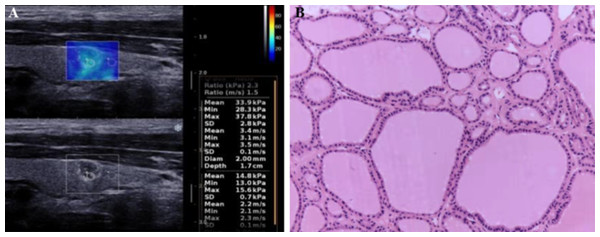 Shear wave elastography and histopathological examination for a benign thyroid nodule in a 43-year-old women.