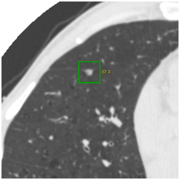 CT image of a typical perifissural nodule attached to a fissure.