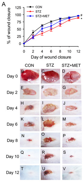 Metoprolol (MET) accelerated wound closure rates in STZ-induced diabetic mice (STZ).
