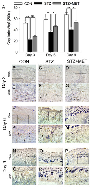 Metoprolol (MET) stimulated angiogenesis in STZ-induced diabetic mice.