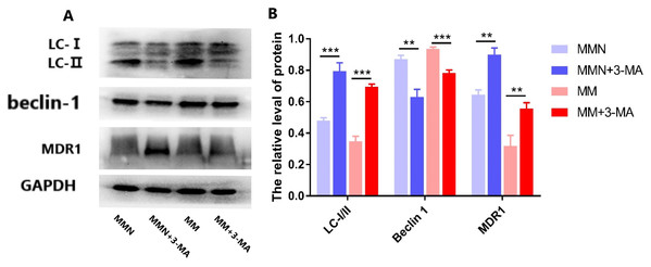 Effect of autophagy inhibitor on miR-145-mediated resistance of ALL cells to glucocorticoid.