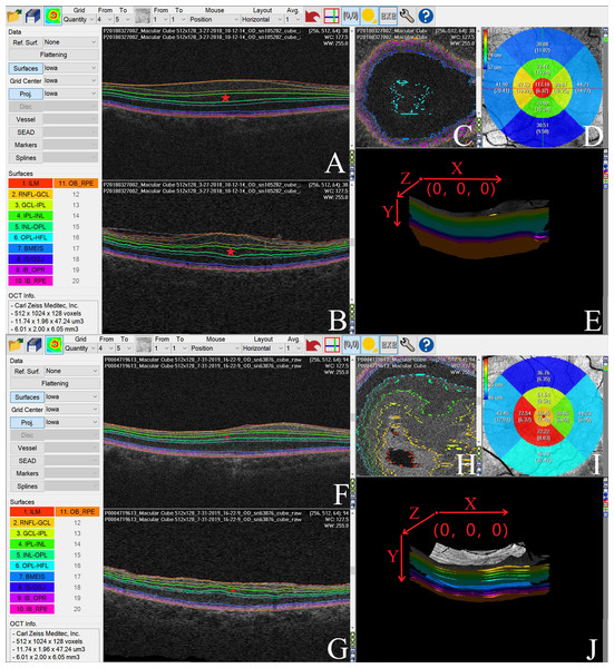 We used the Iowa Reference Algorithm to segment and measure the thickness of individual retinal layers in pre- and postoperative optical coherence tomography (OCT) images of one patient with ERM.