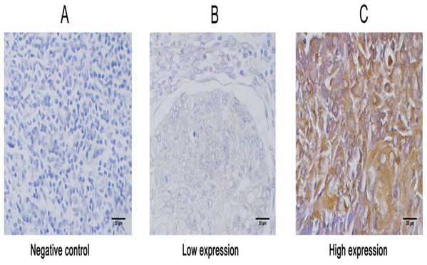 Representative images of immunohistochemical staining for KIAA1199 expression in larynx specimens.