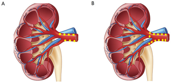 (A) The standard treatment group: spiral ablation from near to proximal, with less than 8 points per artery; (B) the intensive treatment group: from near to far by spiral ablation, with at least 8 points per artery.