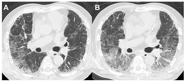 A patient in their 60s with chronic hypersensitivity pneumonia.