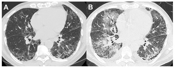 A patient in their 60s with interstitial pneumonia with connective tissue disease.