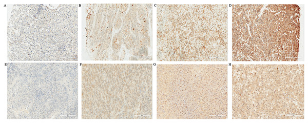 Expressions of Galectin-3 and Galectin-9 in liver tissues of tumor (SP, ×200).