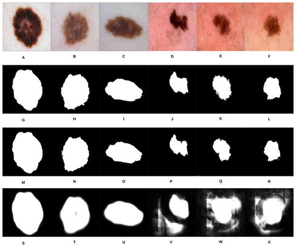 Samples of our proposed segmentation method and U-Net results, where (A–F) represent the original skin lesion images, (G–L) represent the groundtruth images, (M–R) are our method’s results, and (S–X) depict the U-Net results.