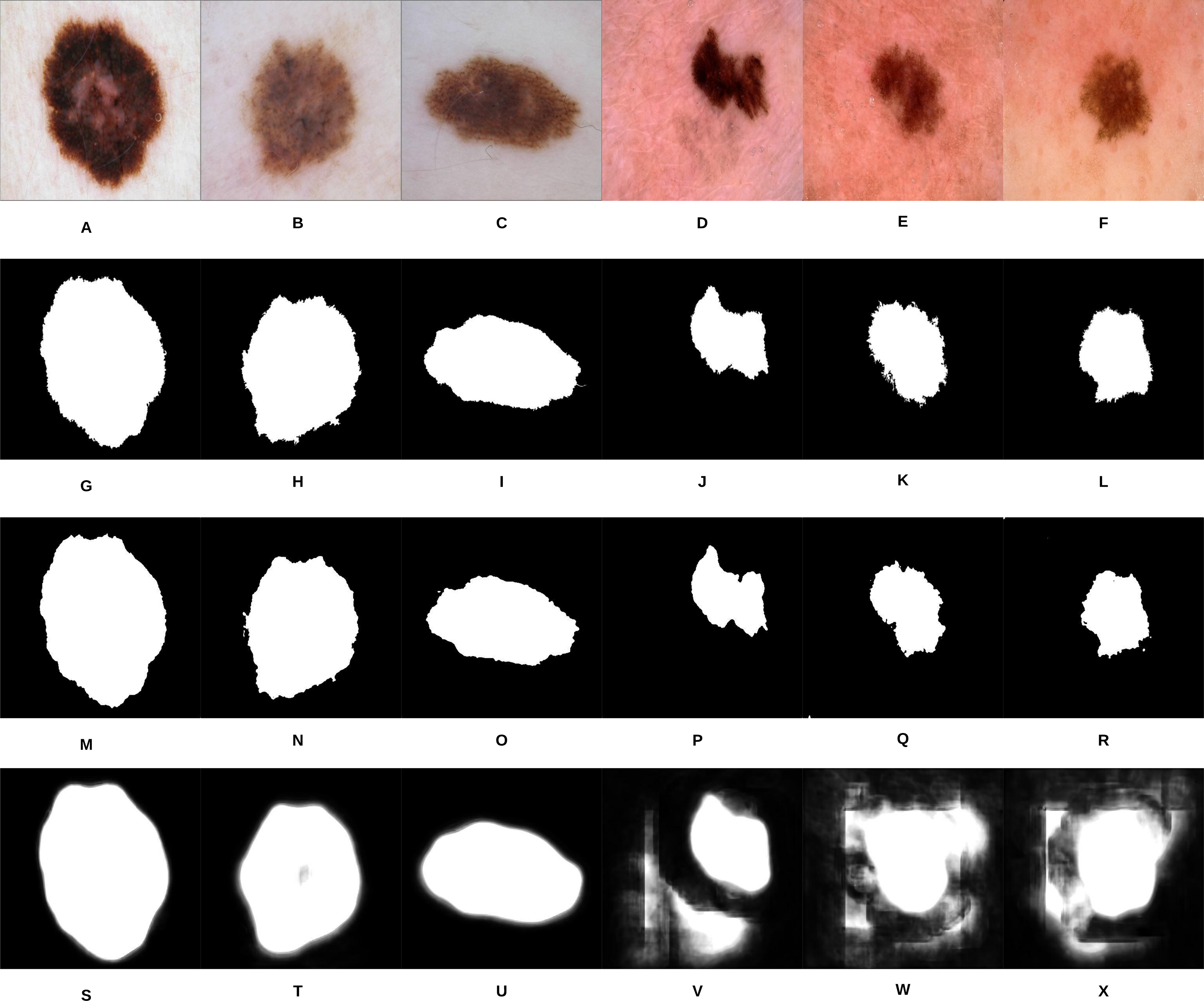 A Machine Learning Approach To Automatic Detection Of Irregularity In Skin Lesion Border Using Dermoscopic Images Peerj