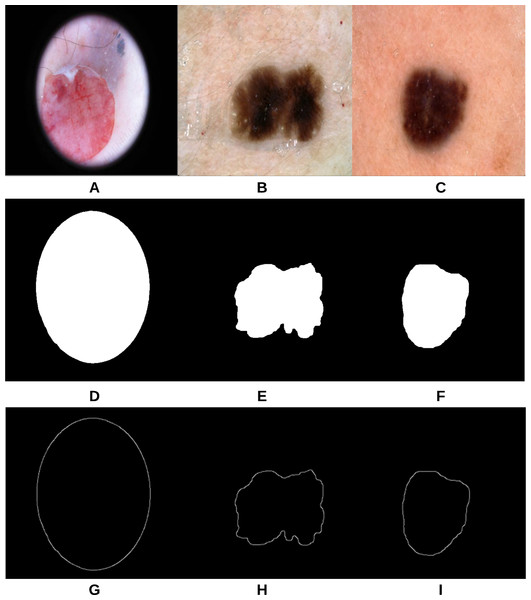 Samples of test images (A–C), smoothed segmented output (D–F) and their extracted skin lesion borders (G–I).