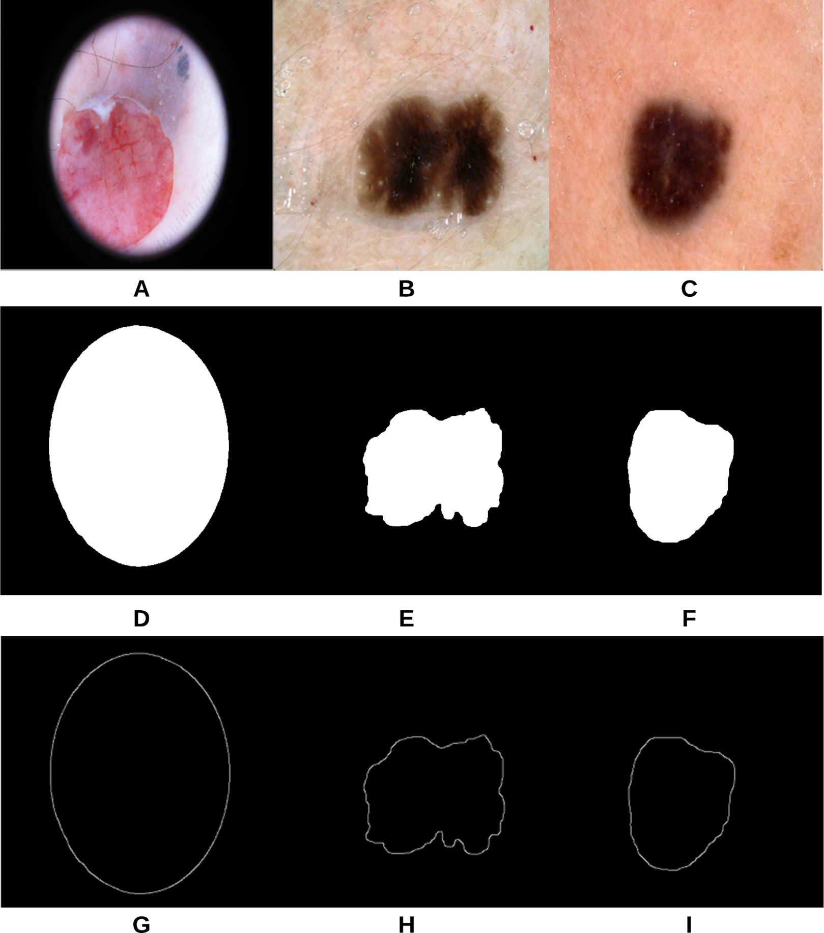 A Machine Learning Approach To Automatic Detection Of Irregularity In Skin Lesion Border Using Dermoscopic Images Peerj