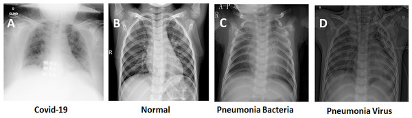 Examples of input X-ray images from the adopted datasets.