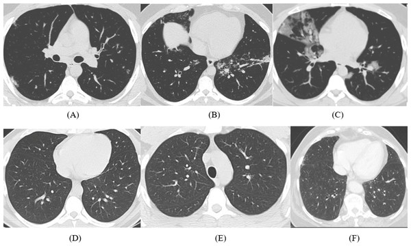 Samples of CT images (A)–(C) COVID-19 CT images and (D)–(F) non-COVID-19 CT images.
