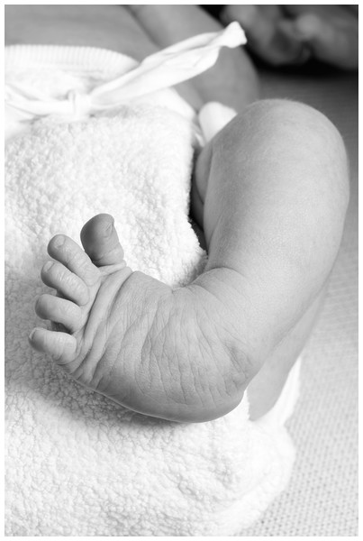 Example of clubfoot with rounded lateral border. Figure source: iStock.