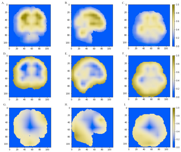 The horizontal (x = 50), sagittal (y = 50), and coronal (z = 50) view of the brain MRI and visual explanation heatmaps generated from 3D-ResNet (A–F) and 3D-VGGNet (G, H, I).